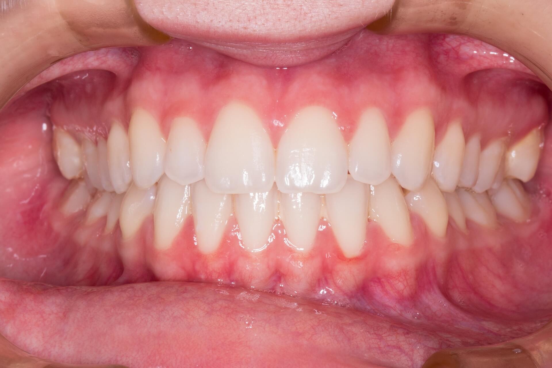 Before dental treatment